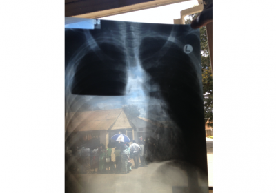 Ornella Punzo, Pleural effusion in a TB patient in the TB ward of Bwaila hospital, Lilongwe, Malawi